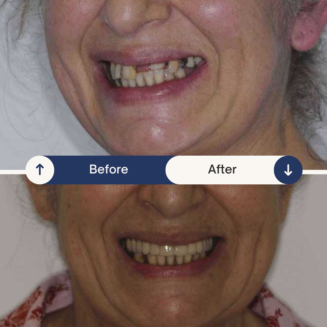 dental implant before and after