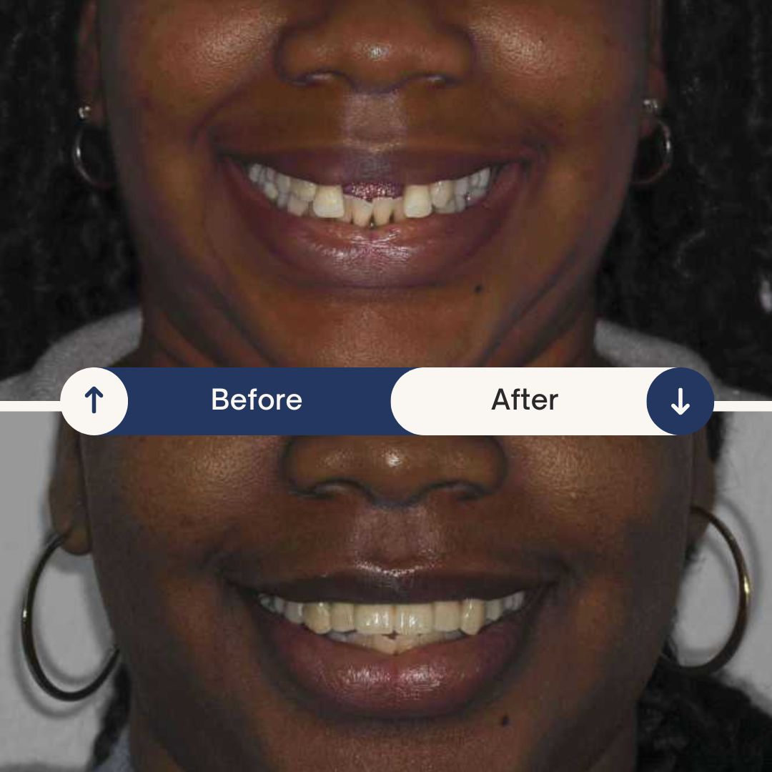dental implant before and after