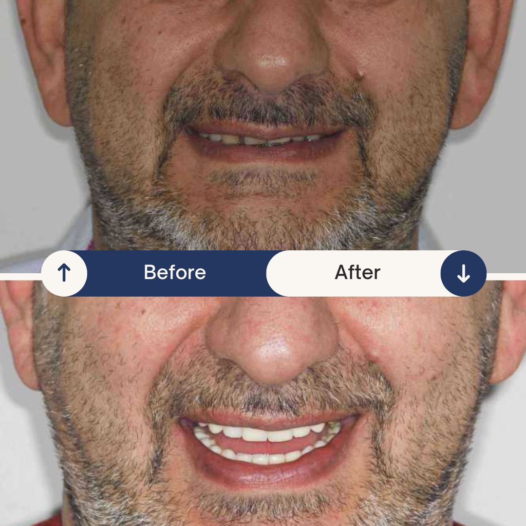 dental implant before and after