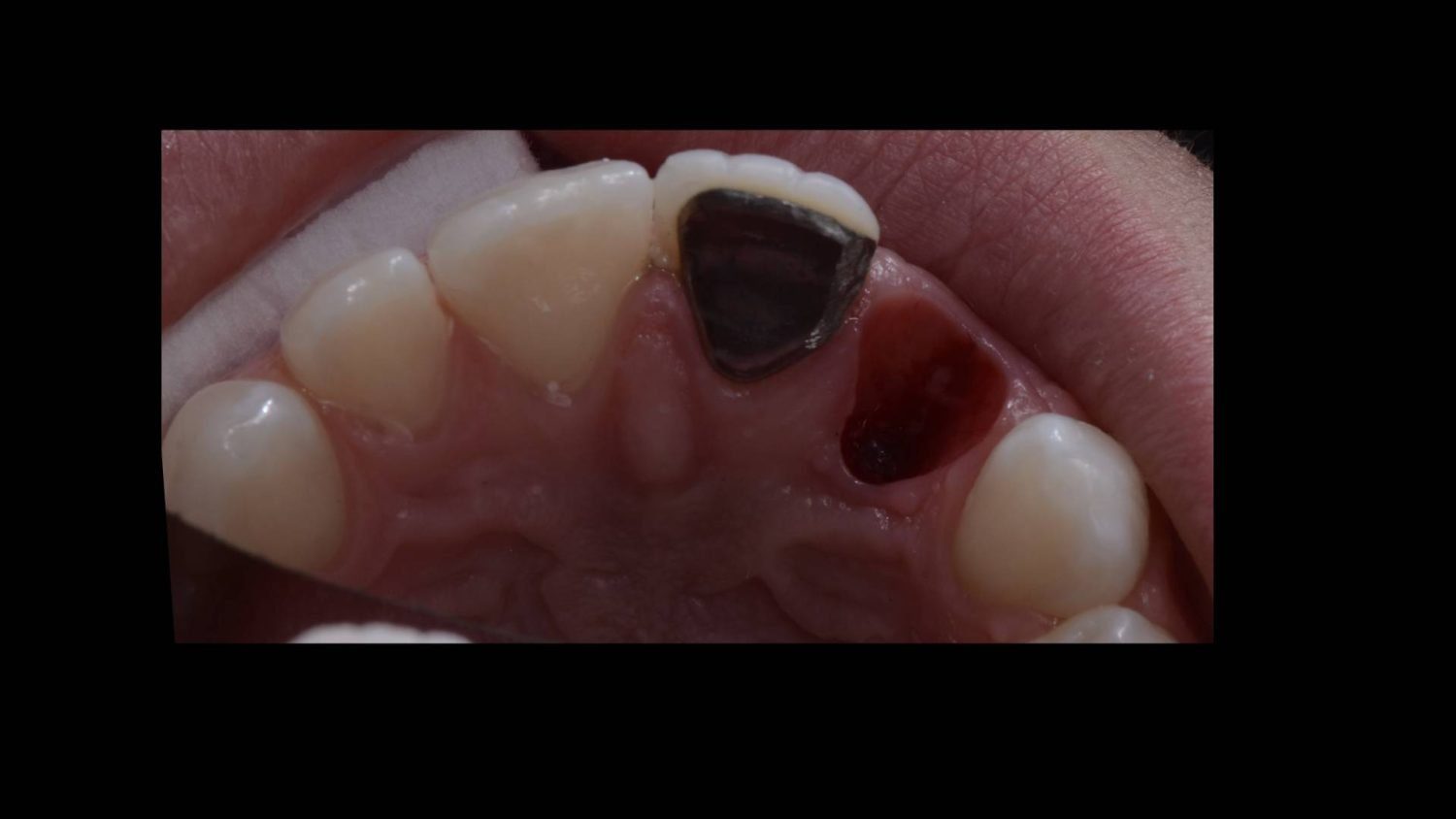 missing tooth