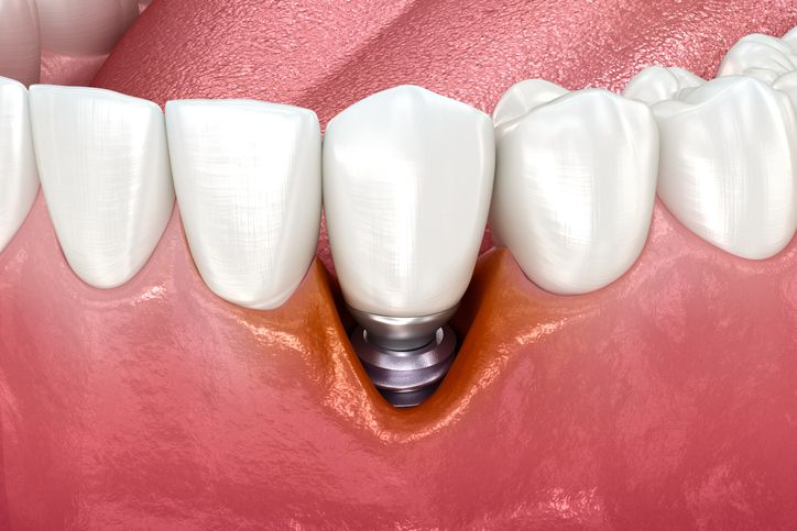 Diagnosing and Treating Peri-implantitis