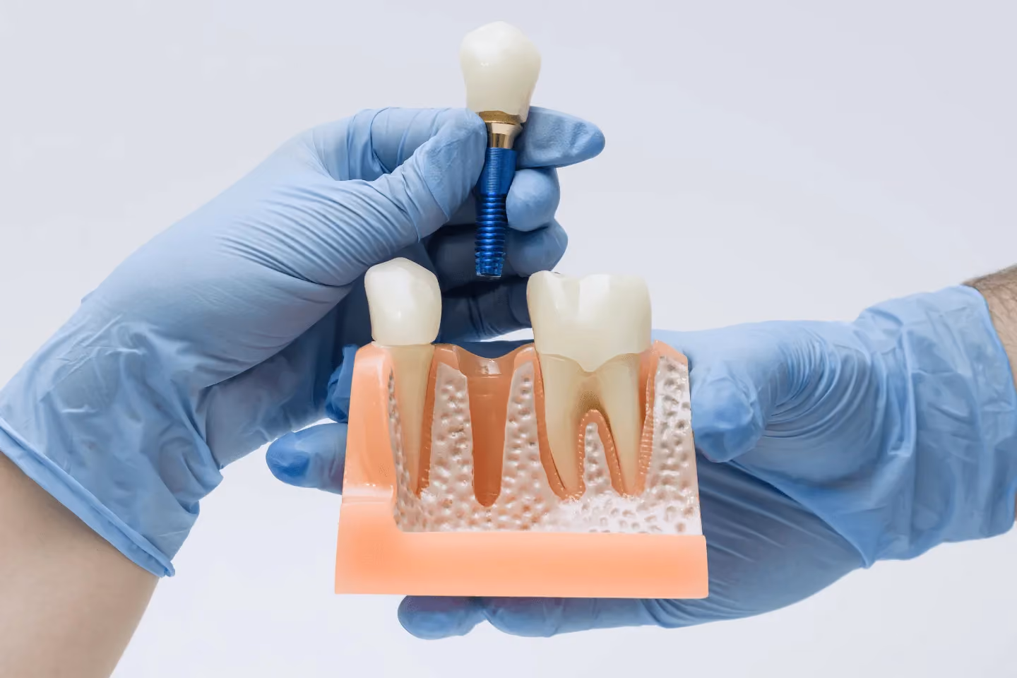 Dental implant treatment slide at Maida Smiles dental clinic, Maida Vale, London