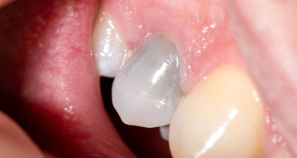 black tooth image