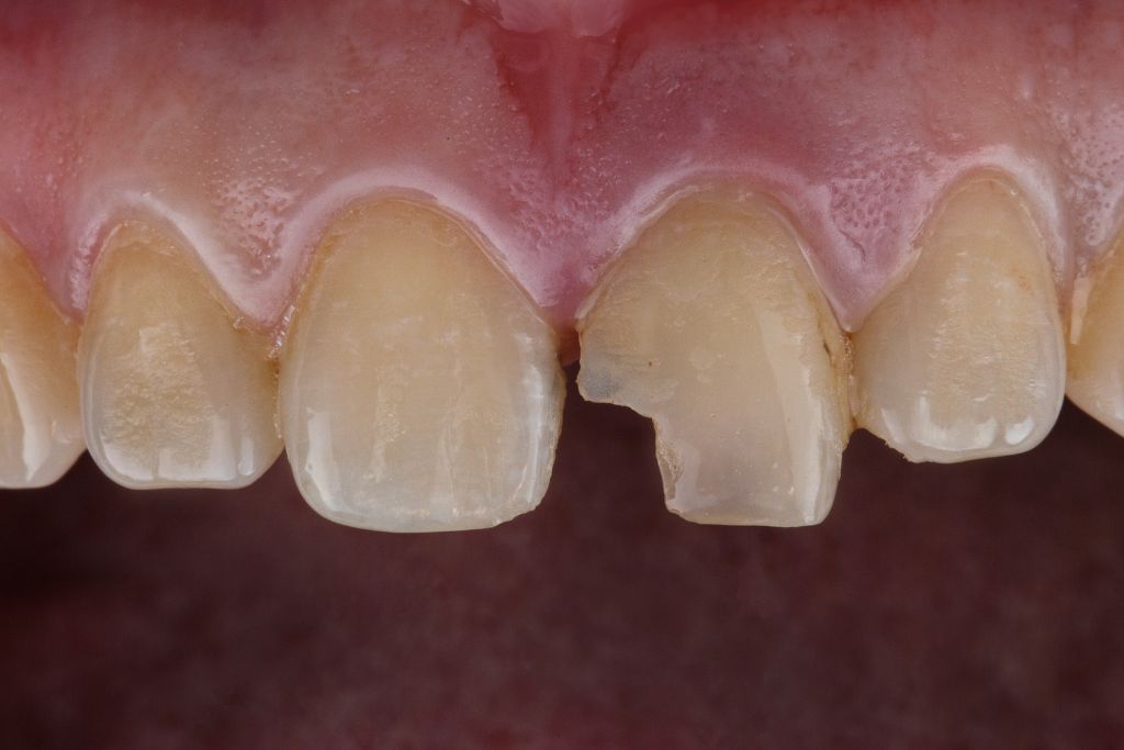broken tooth image