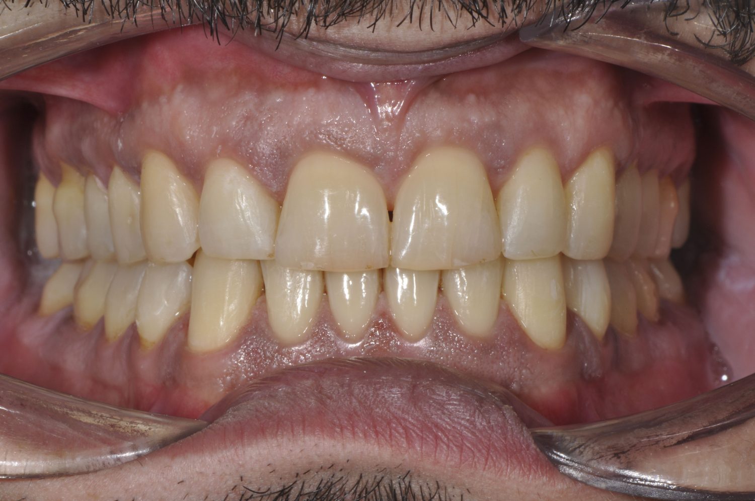 Crooked, worn teeth after treatment at Maida Smiles