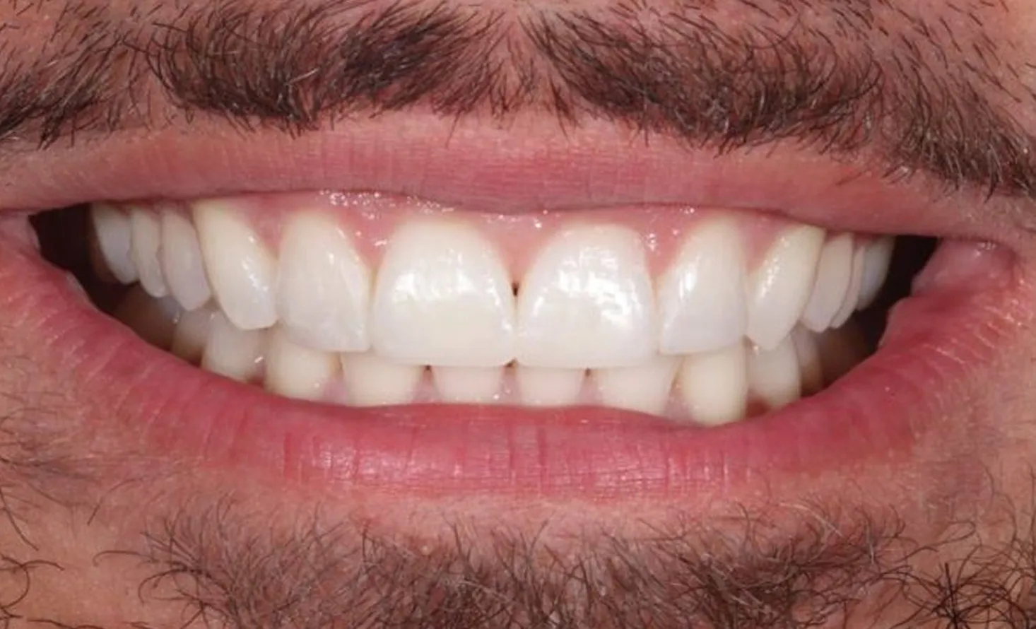 Patient smile after composite bonding at Maida Smiles, Maida Vale
