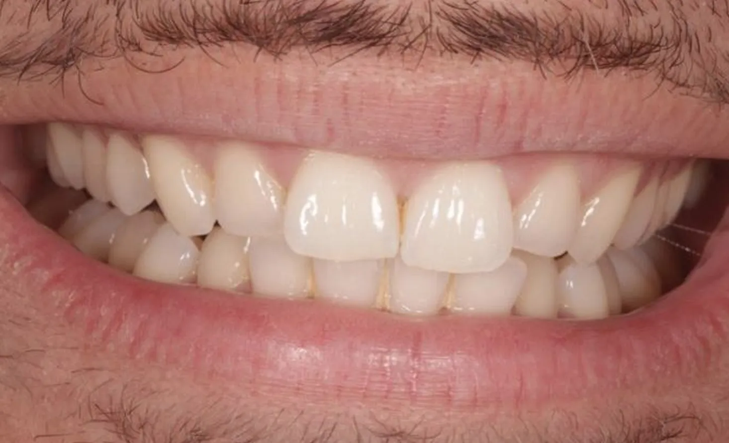 Patient teeth before composite bonding at Maida Smiles