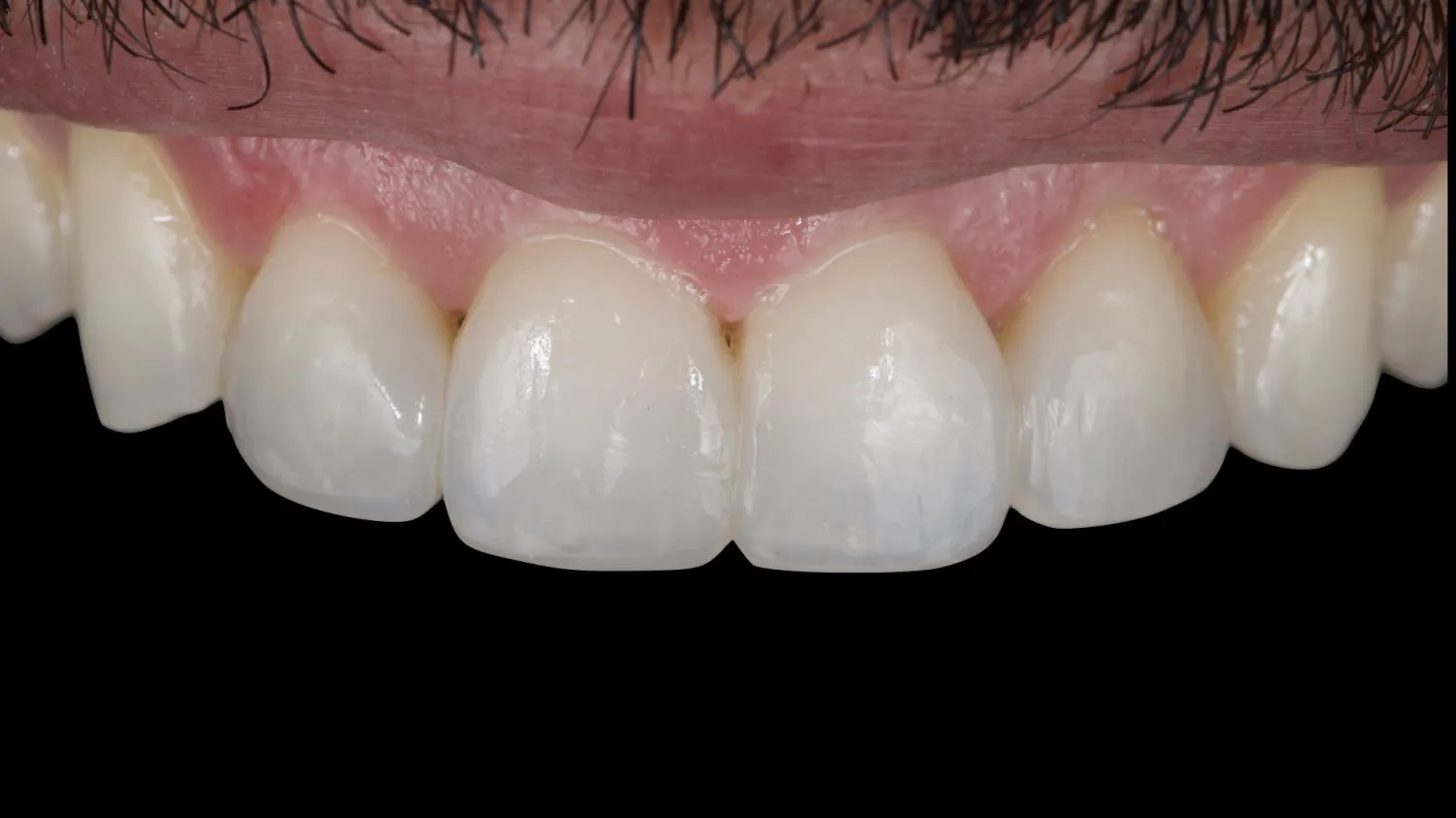 Patient smile after composite bonding at Maida Smiles, Maida Vale