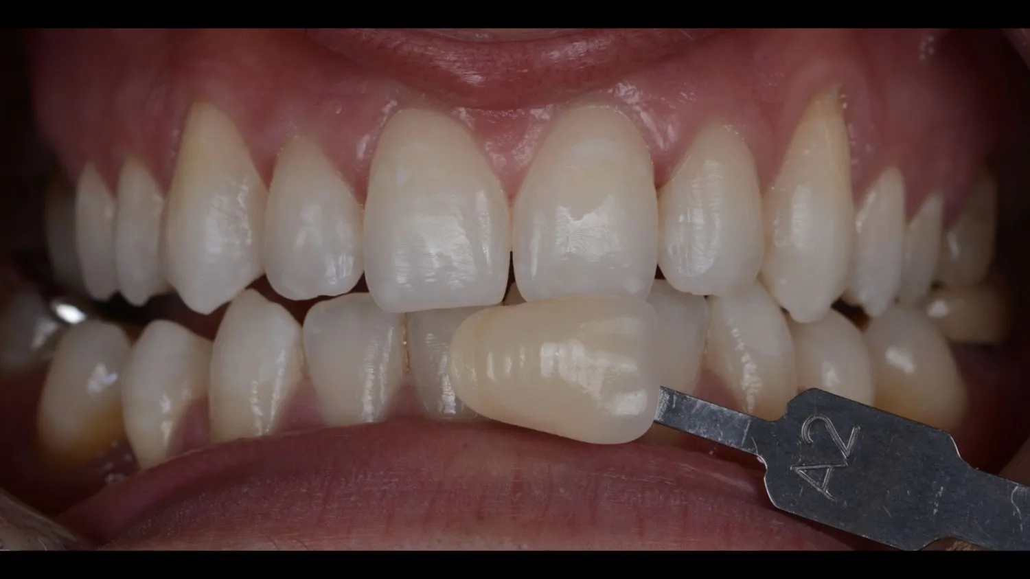 Patient smile after teeth whitening at Maida Smiles, Maida Vale