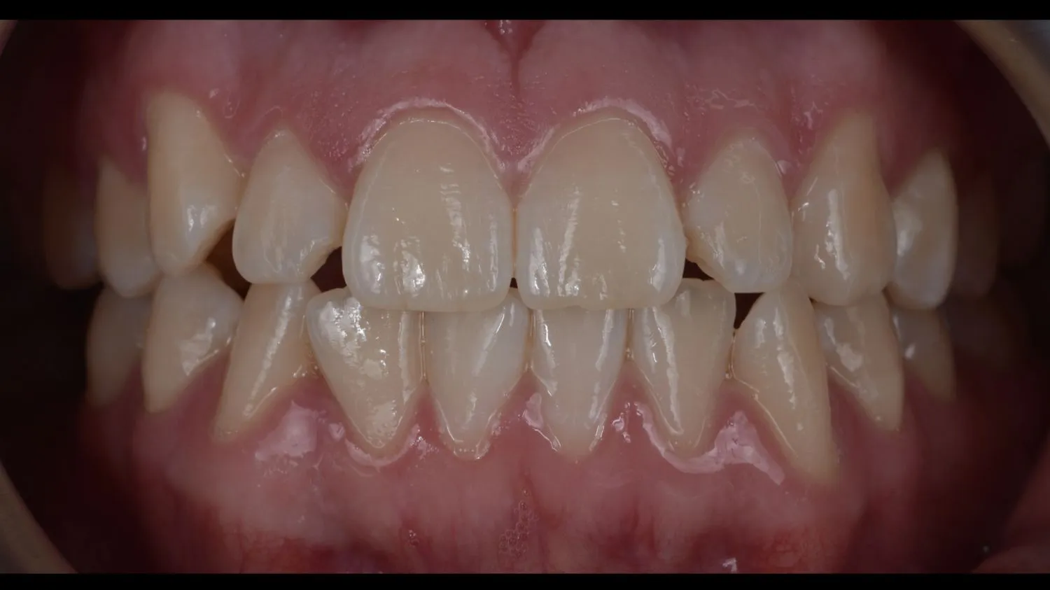 Patient teeth before teeth whitening at Maida Smiles
