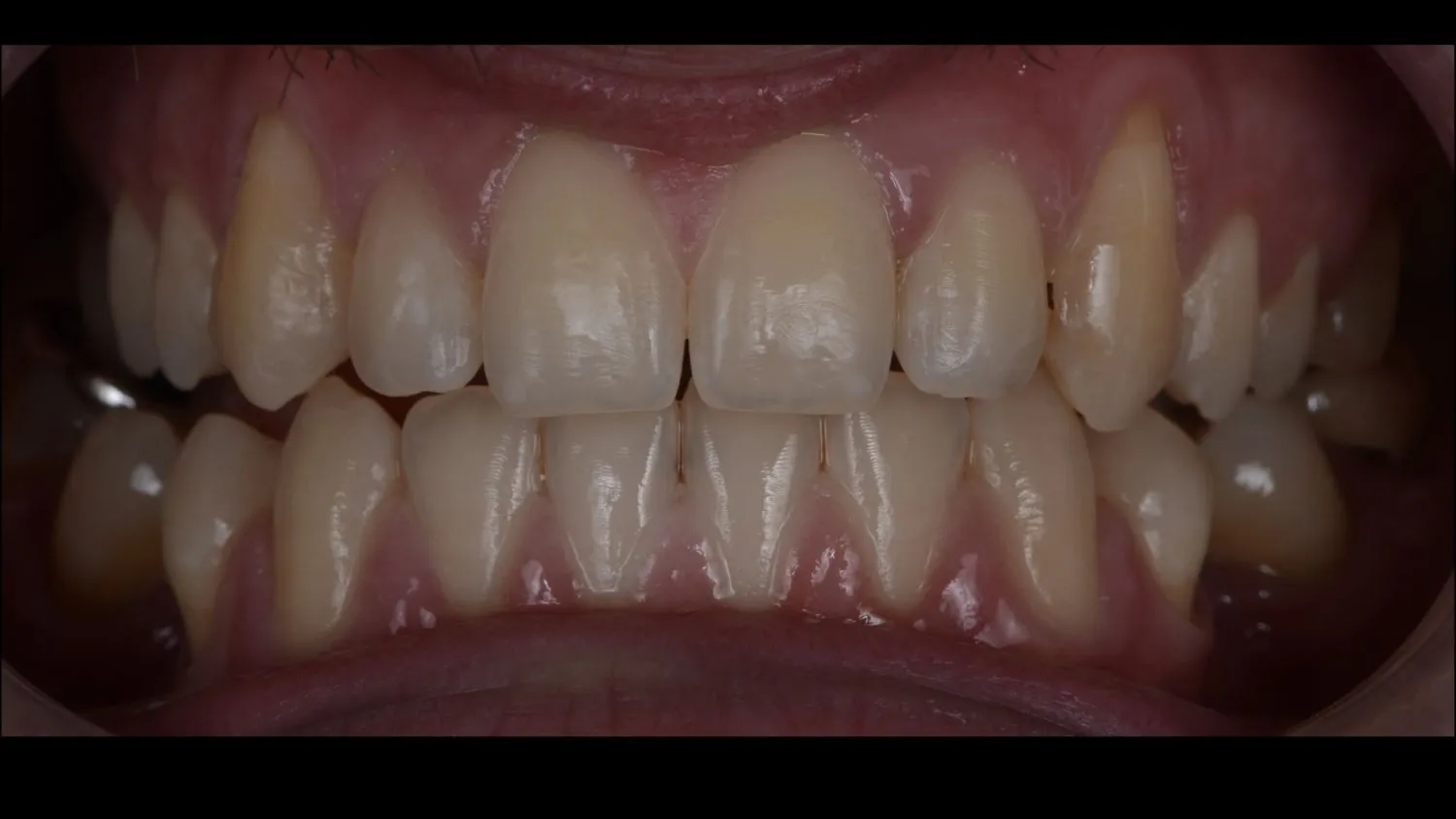 Patient teeth before teeth whitening at Maida Smiles