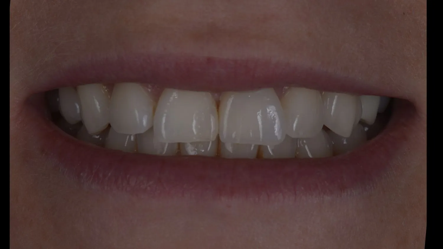 Patient smile after dental crown at Maida Smiles, Maida Vale