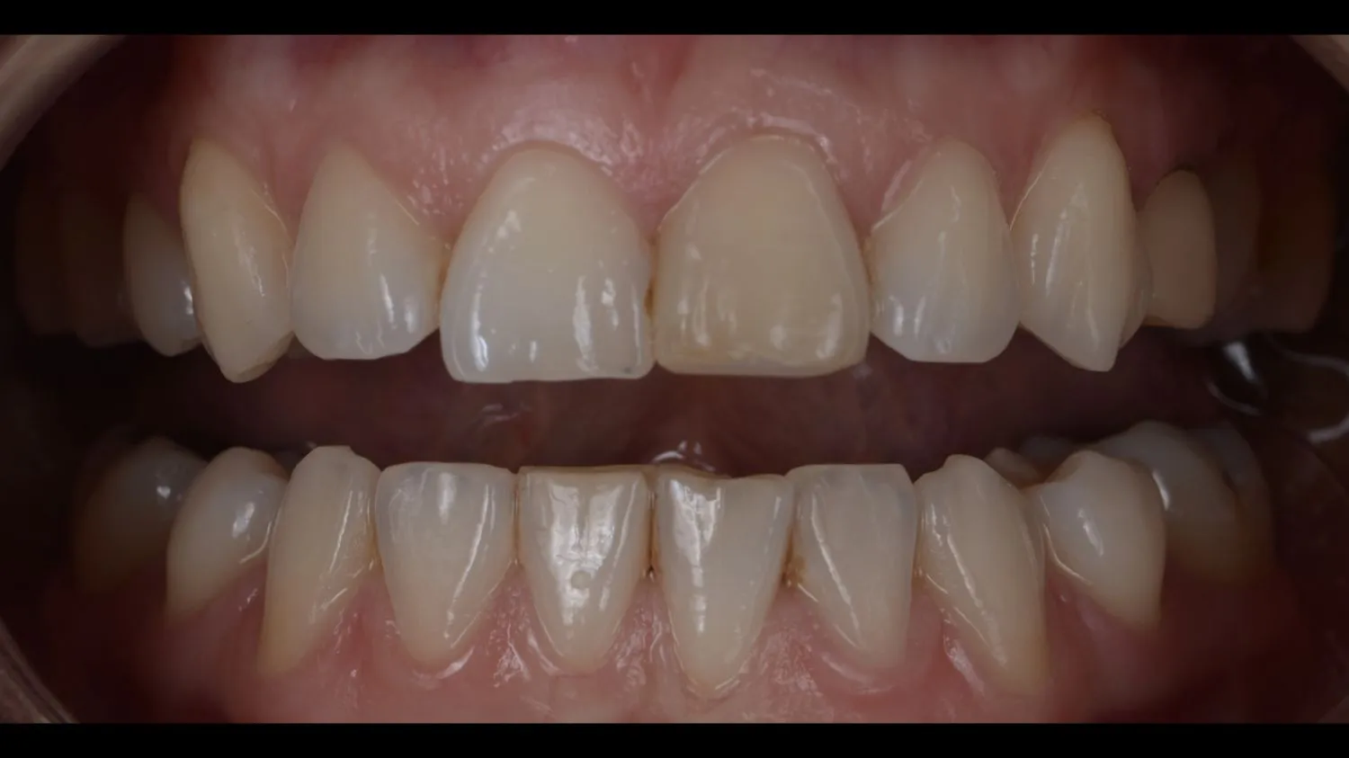 Patient tooth before dental crown at Maida Smiles