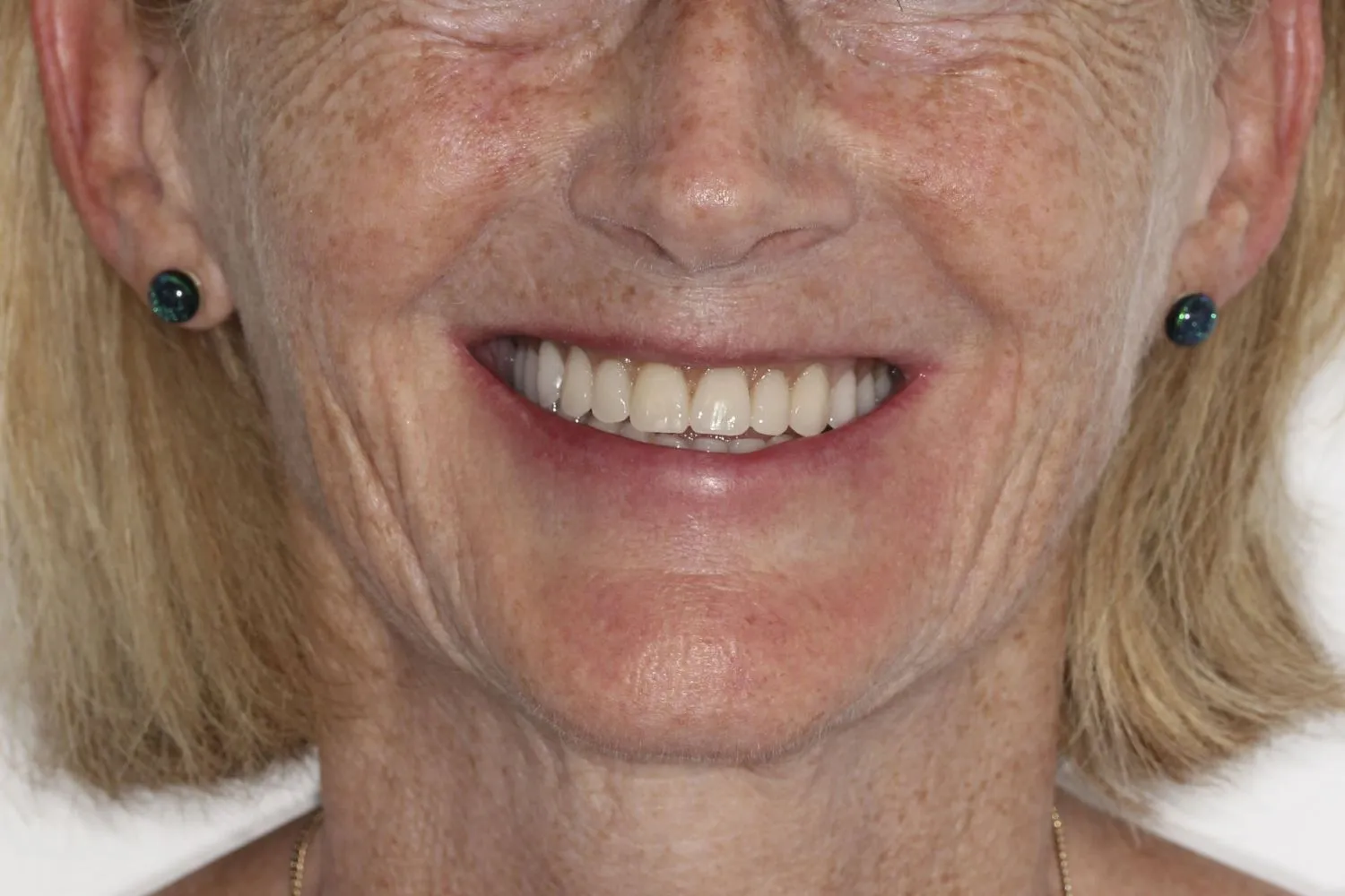 Patient smile after dental implants at Maida Smiles, Maida Vale