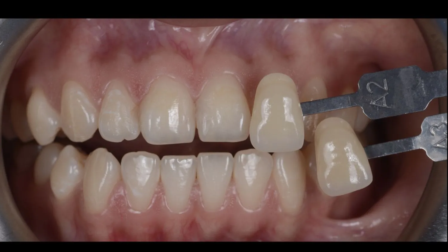 Patient teeth before teeth whitening at Maida Smiles