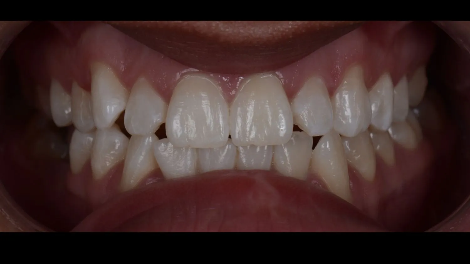 Patient smile after teeth whitening at Maida Smiles, Maida Vale
