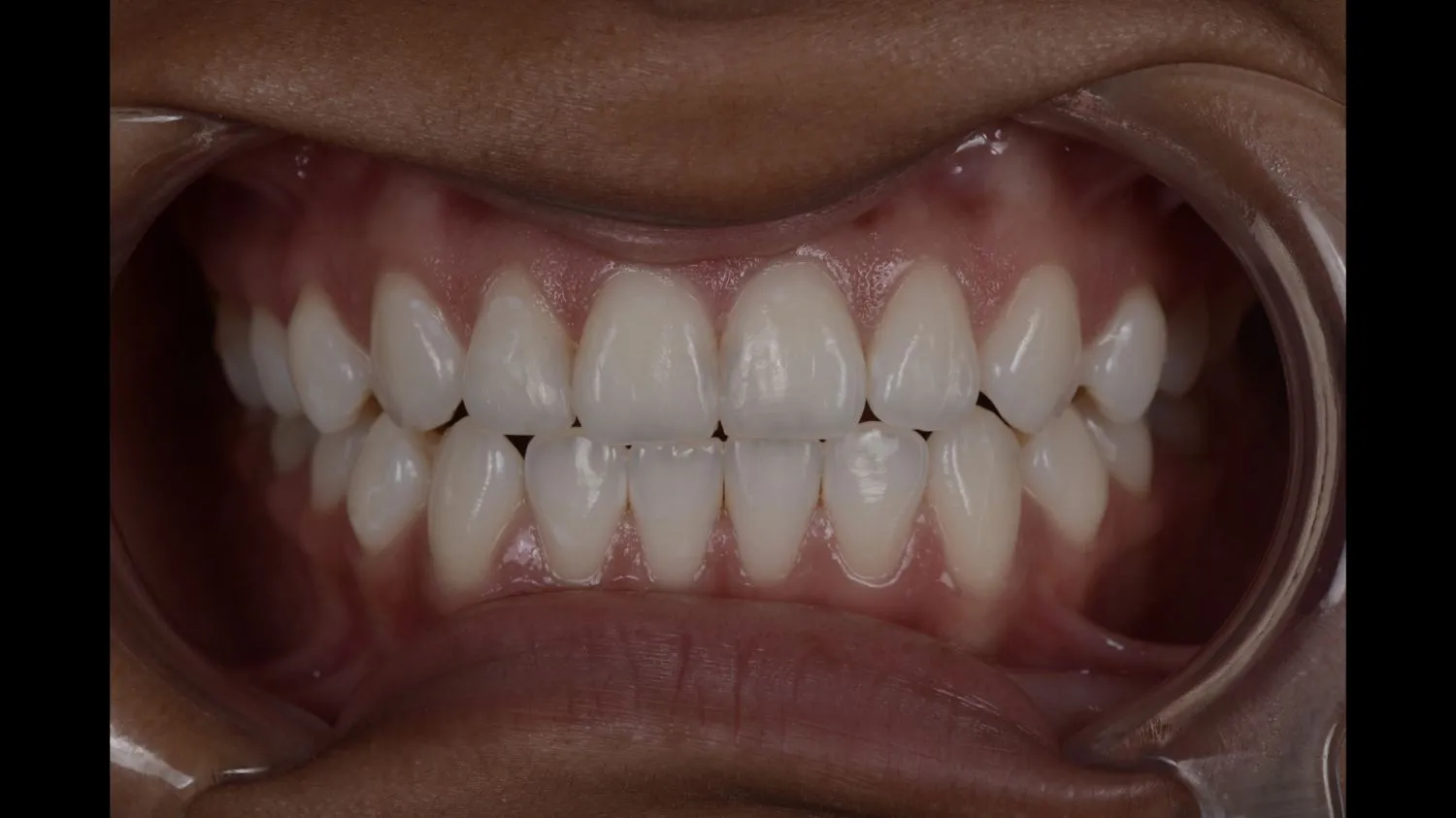 Patient smile after teeth whitening at Maida Smiles, Maida Vale