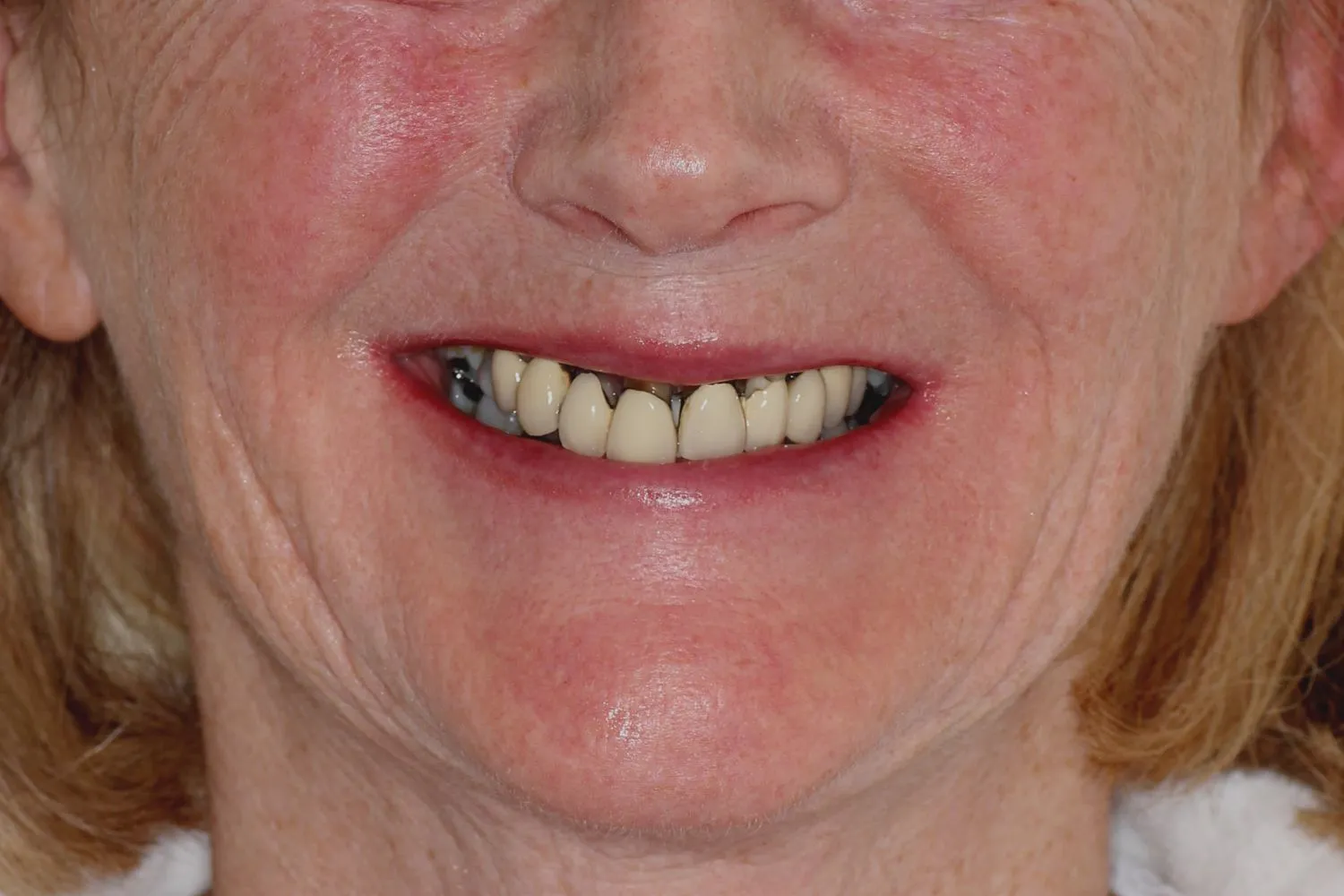 Patient with missing teeth before dental implant treatment at Maida Smiles