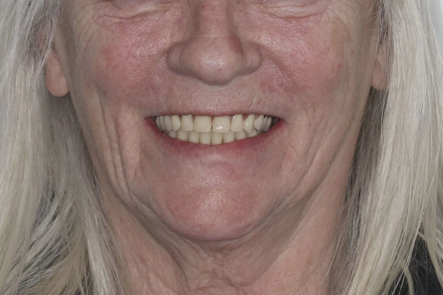 Patient smile after dental implants at Maida Smiles, Maida Vale