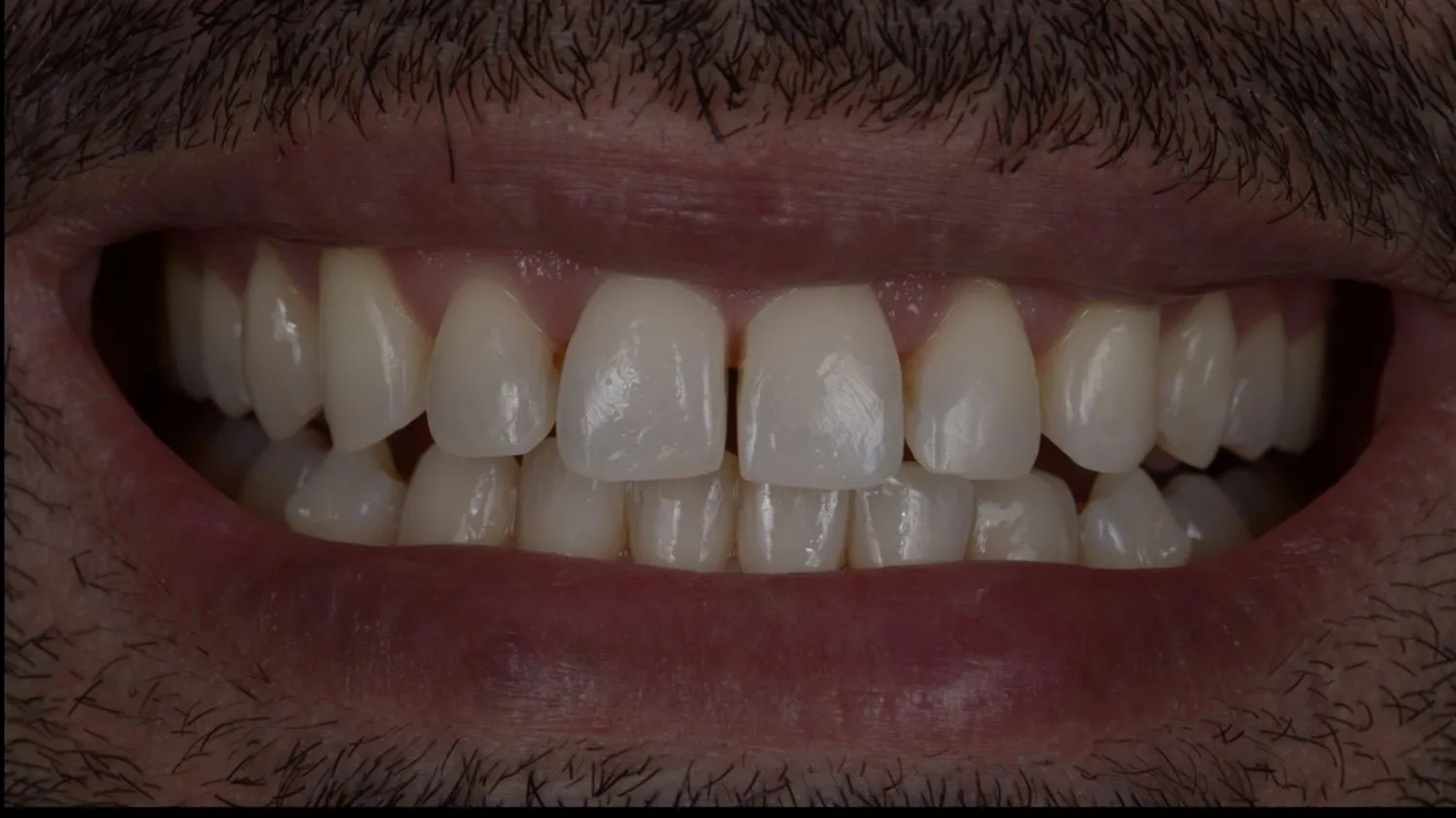Patient teeth before composite bonding at Maida Smiles