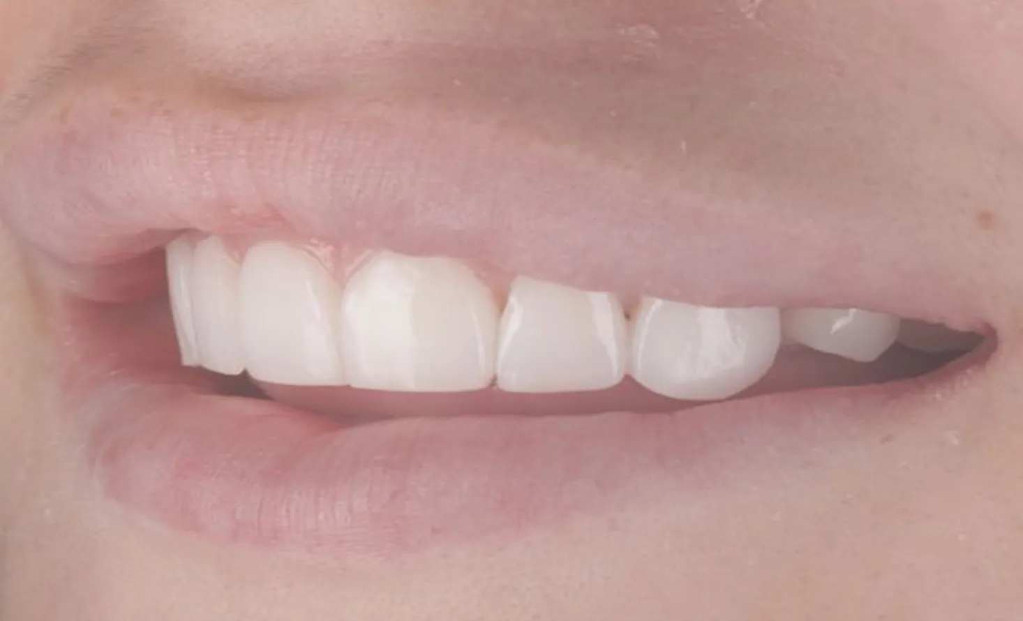 Patient smile after composite bonding at Maida Smiles, Maida Vale