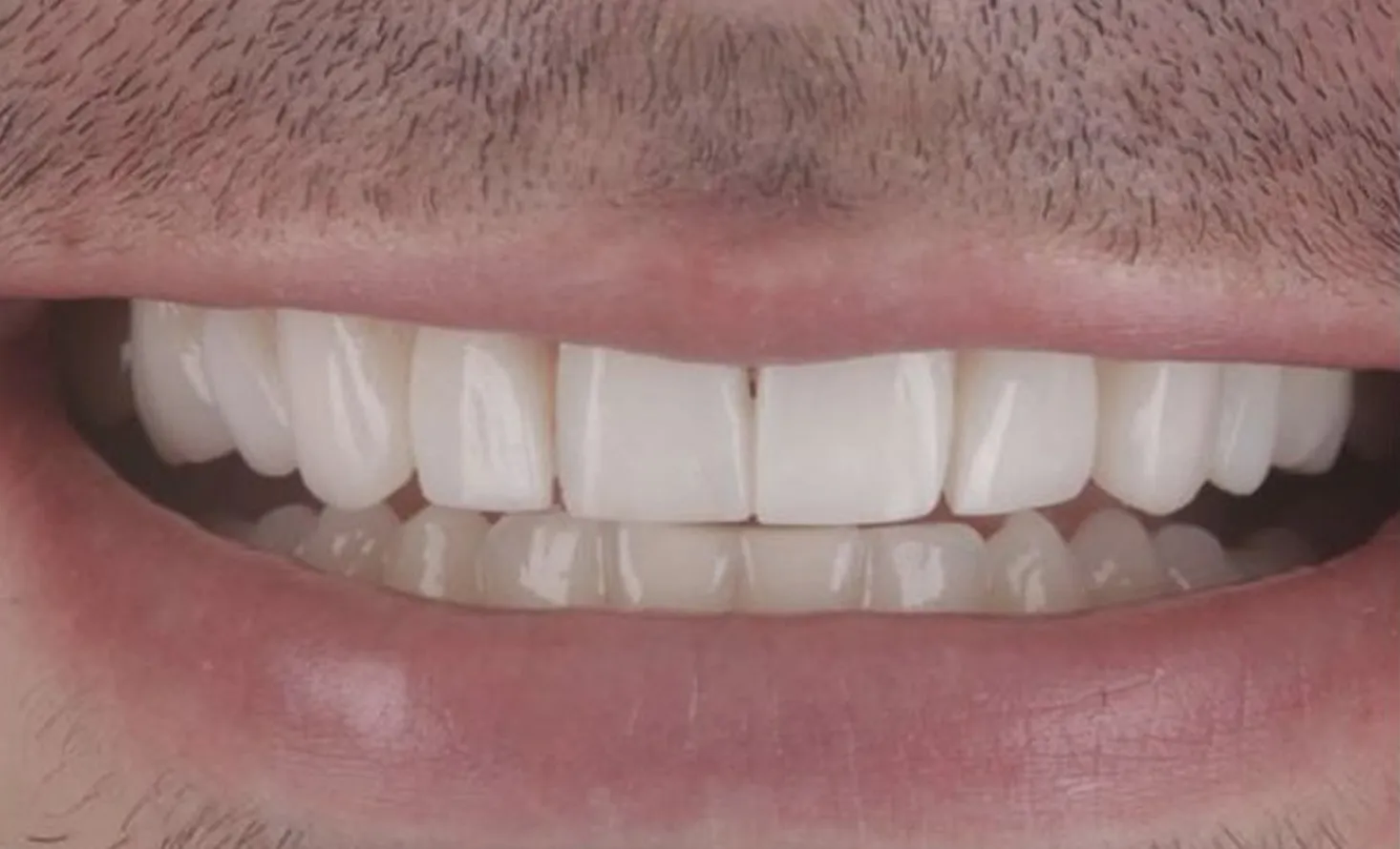 Patient smile after composite bonding at Maida Smiles, Maida Vale