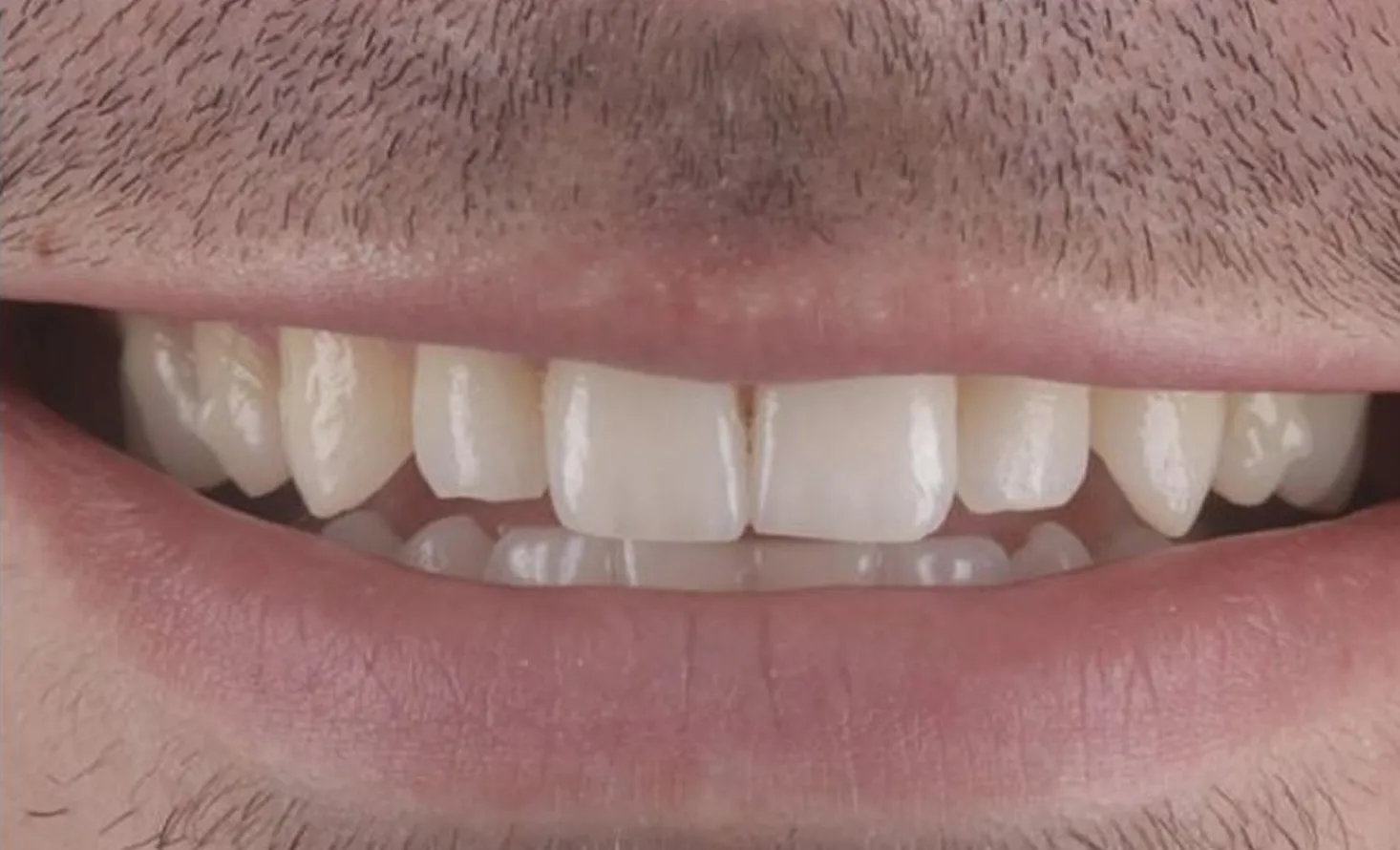 Patient teeth before composite bonding at Maida Smiles