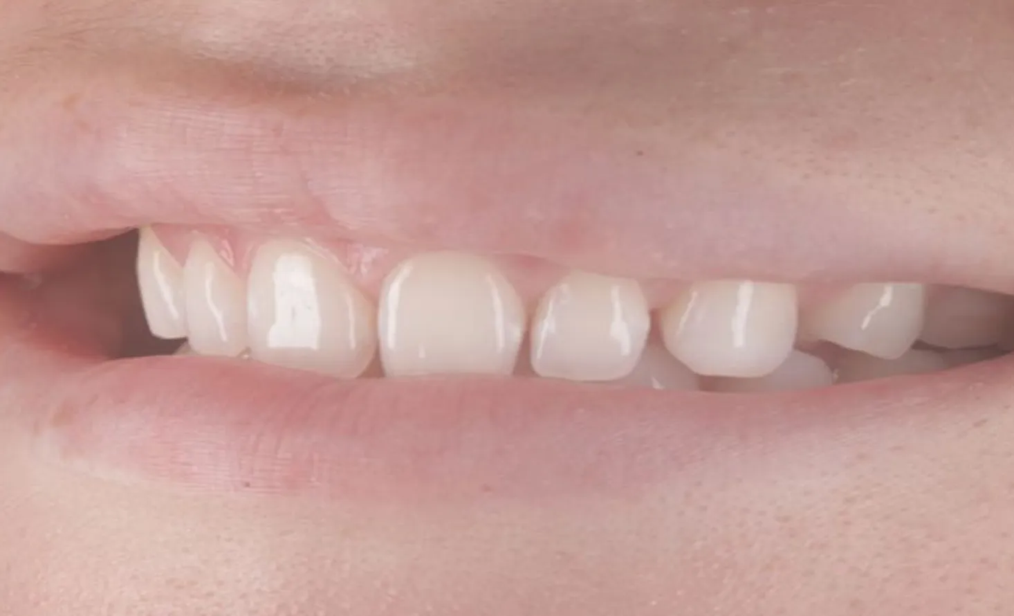 Patient teeth before composite bonding at Maida Smiles