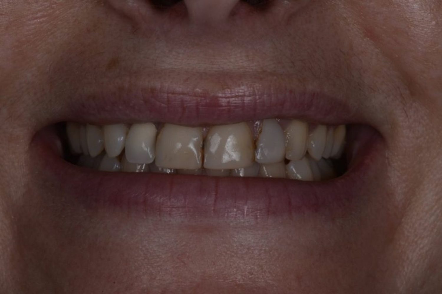 Patient teeth before dental veneers at Maida Smiles