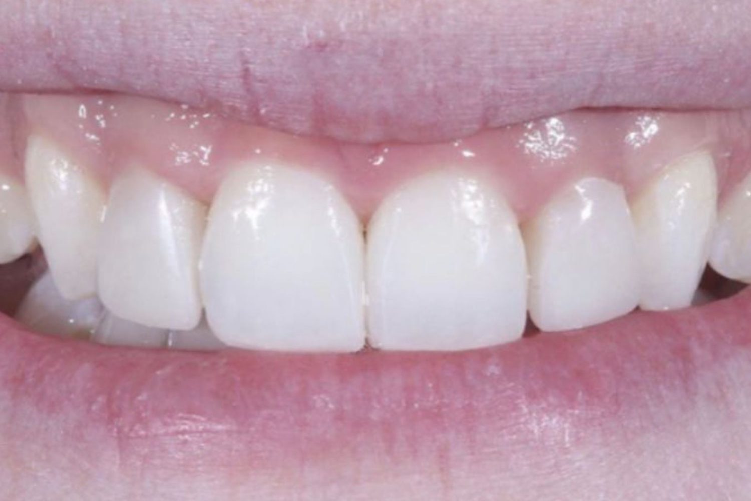 Patient smile after dental veneers at Maida Smiles, Maida Vale