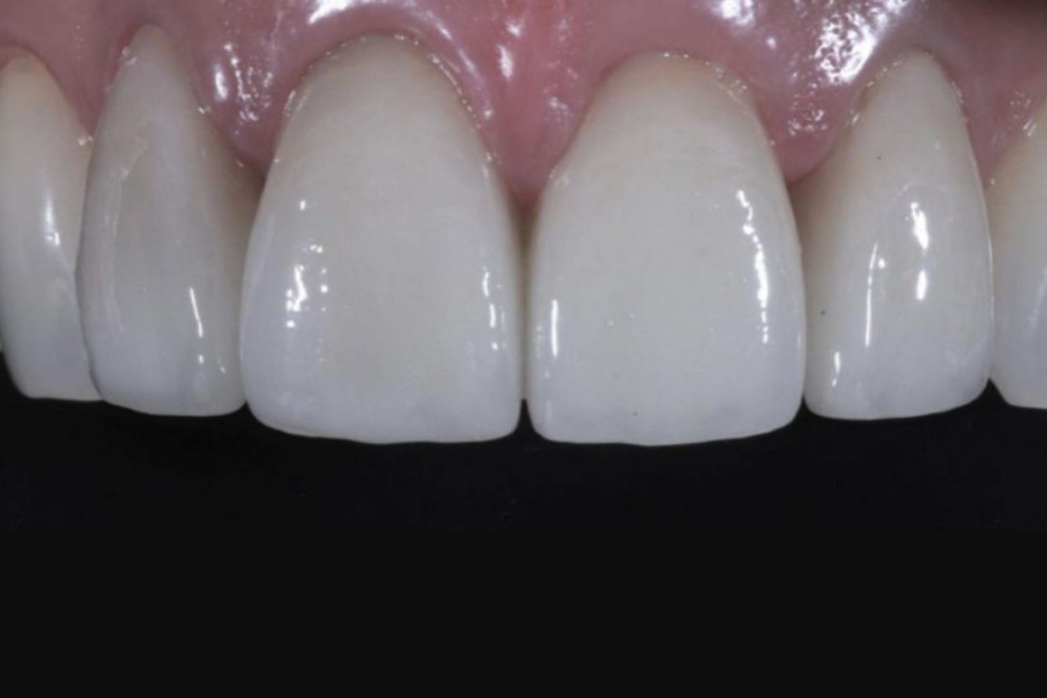 Patient smile after porcelain veneers at Maida Smiles, Maida Vale