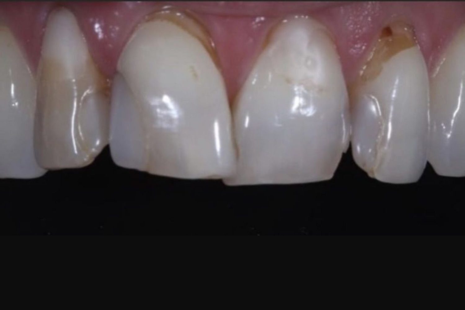 Patient teeth before porcelain veneers at Maida Smiles