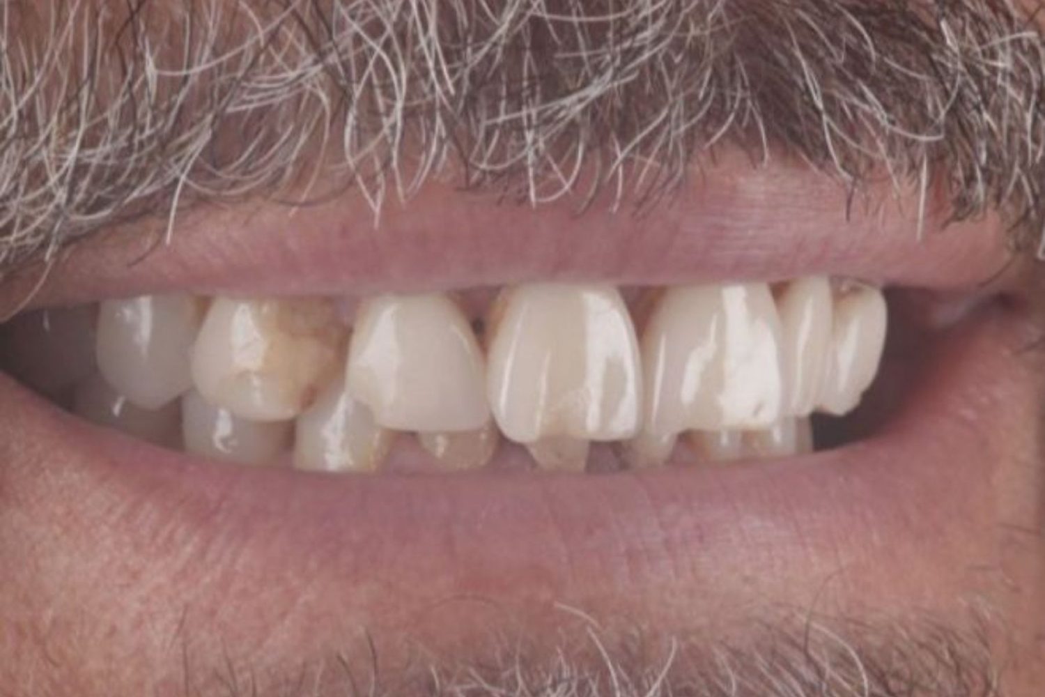 Patient teeth before dental veneers at Maida Smiles