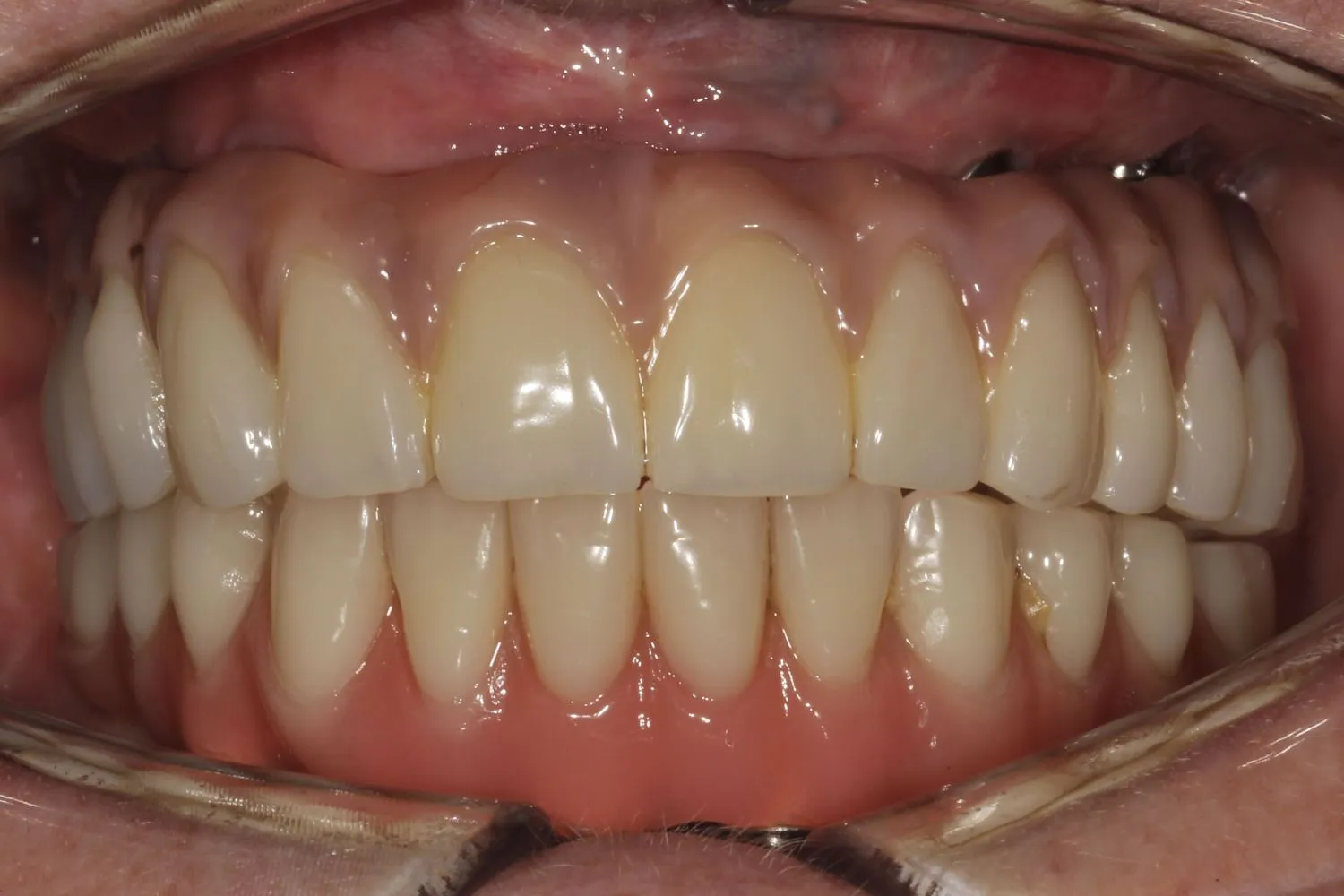 Patient smile after dental implants at Maida Smiles, Maida Vale