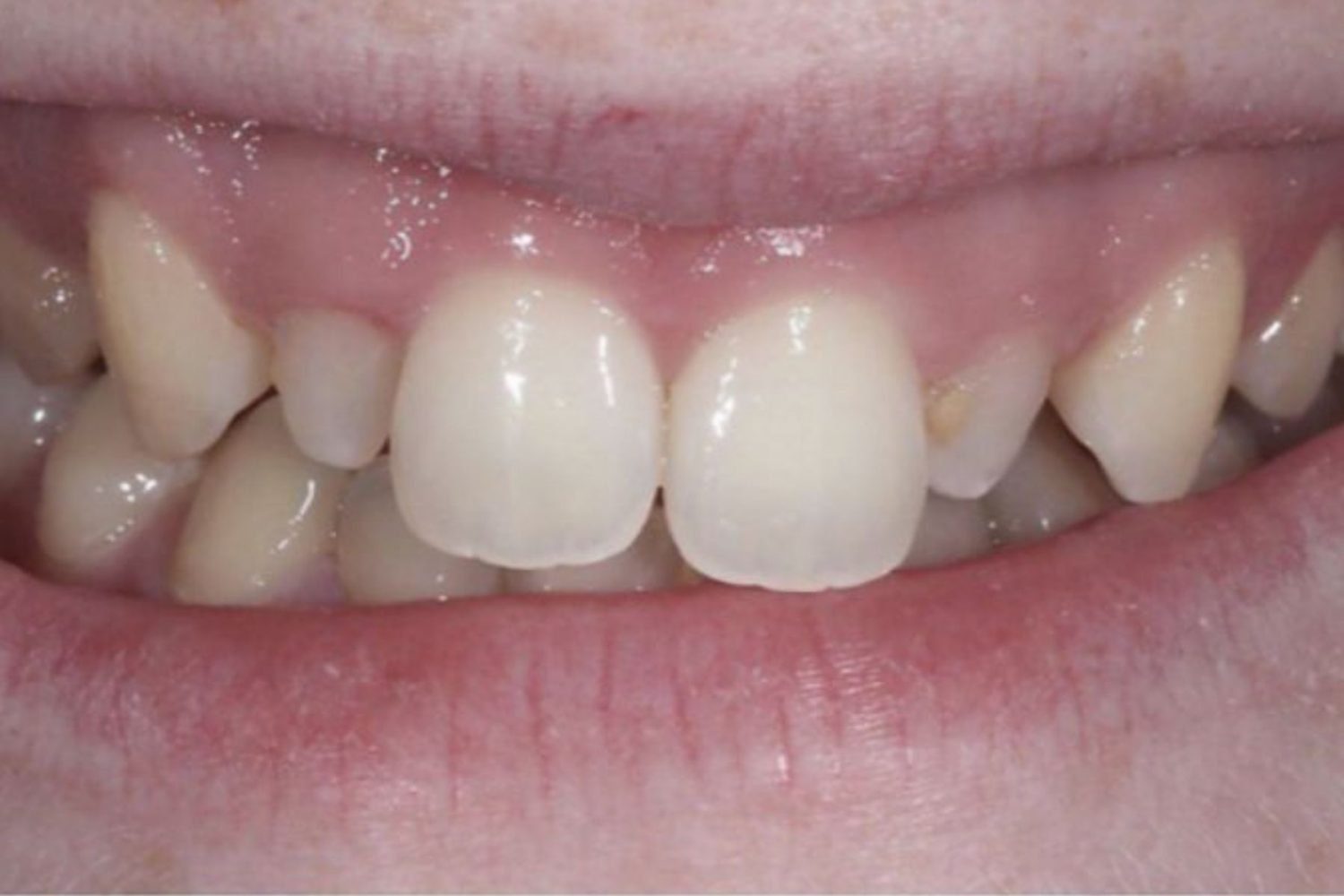 Patient teeth before dental veneers at Maida Smiles