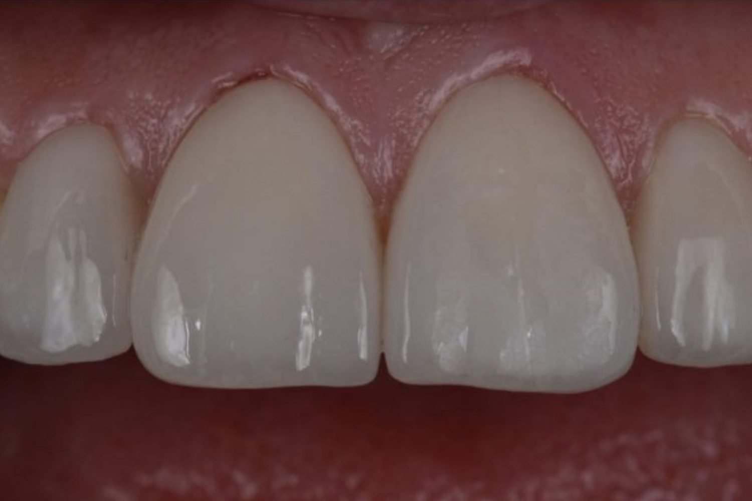 Patient smile after dental veneers at Maida Smiles, Maida Vale