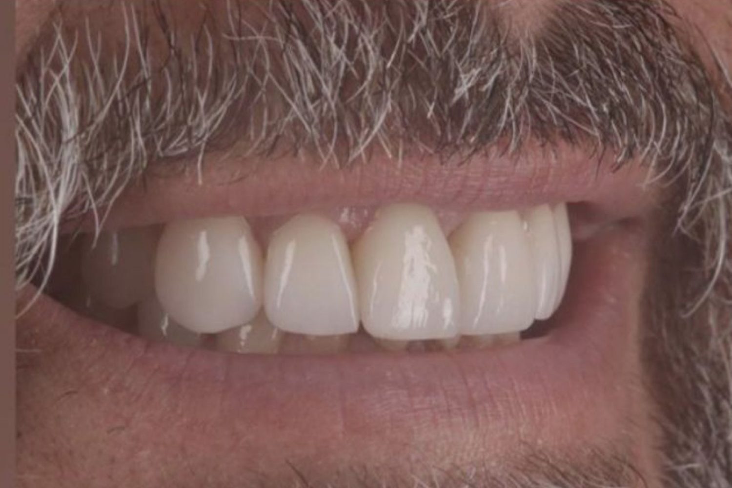 Patient smile after dental veneers at Maida Smiles, Maida Vale