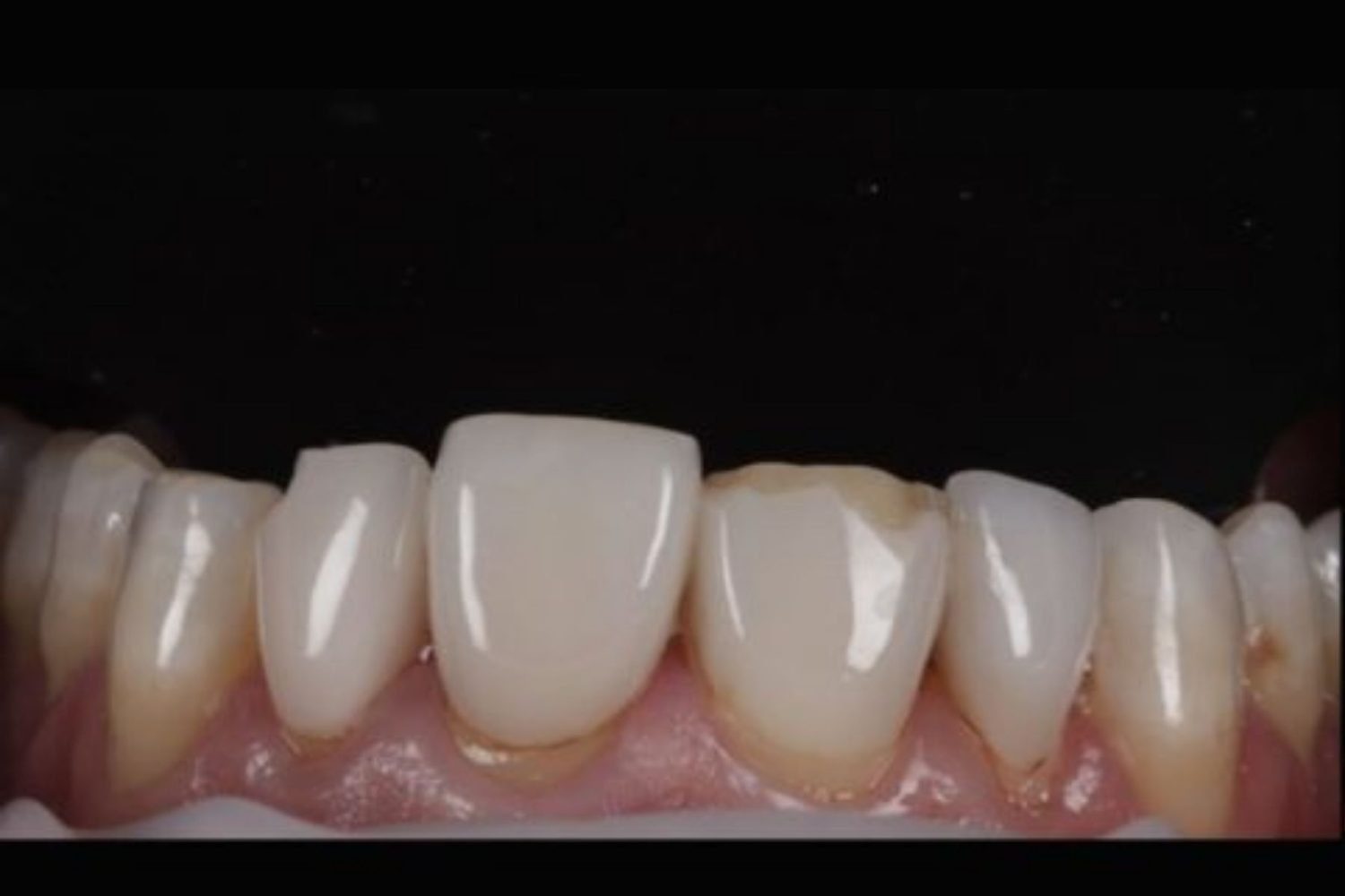 Patient teeth before composite veneers at Maida Smiles