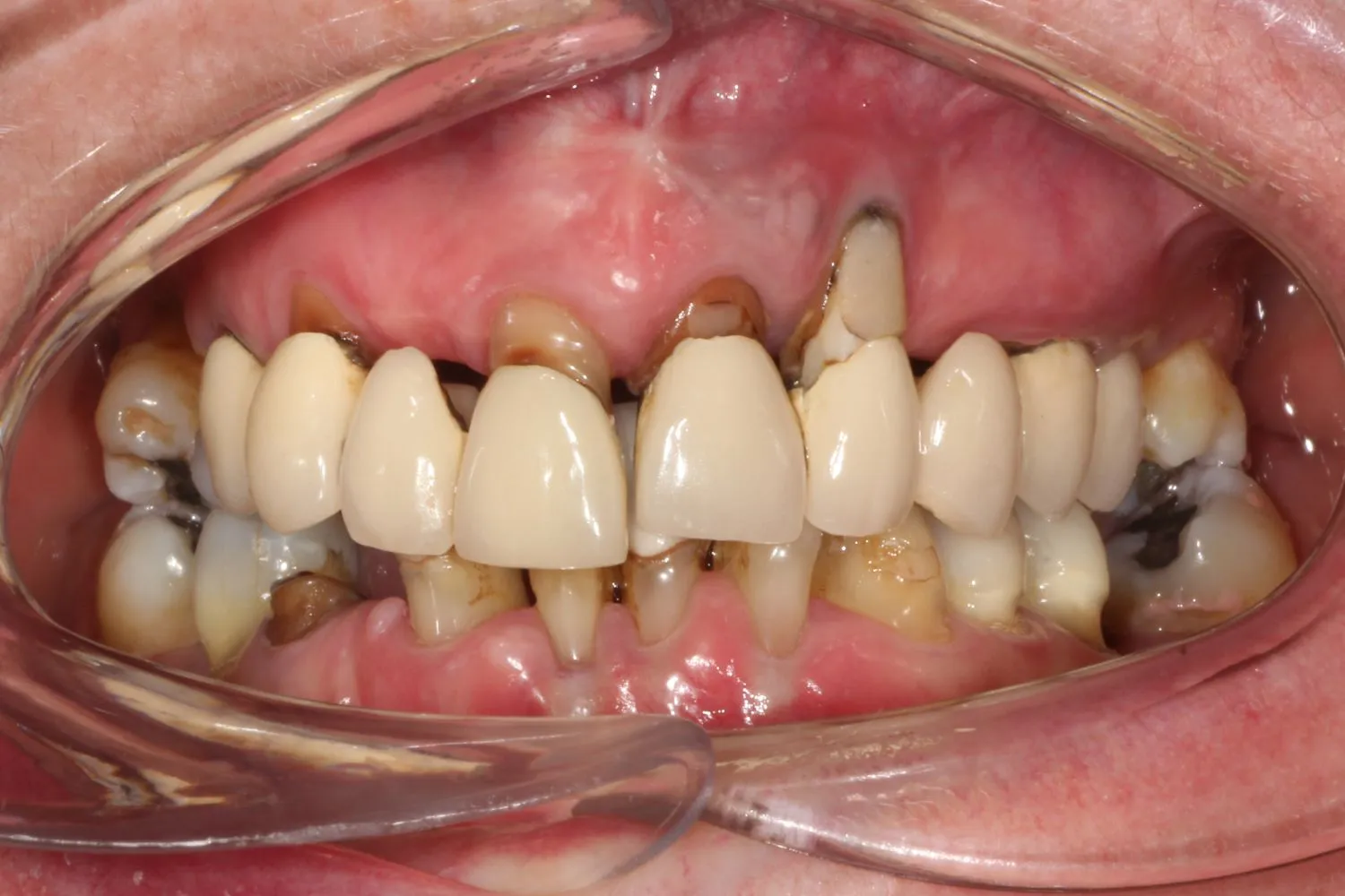 Patient with missing teeth before dental implant treatment at Maida Smiles