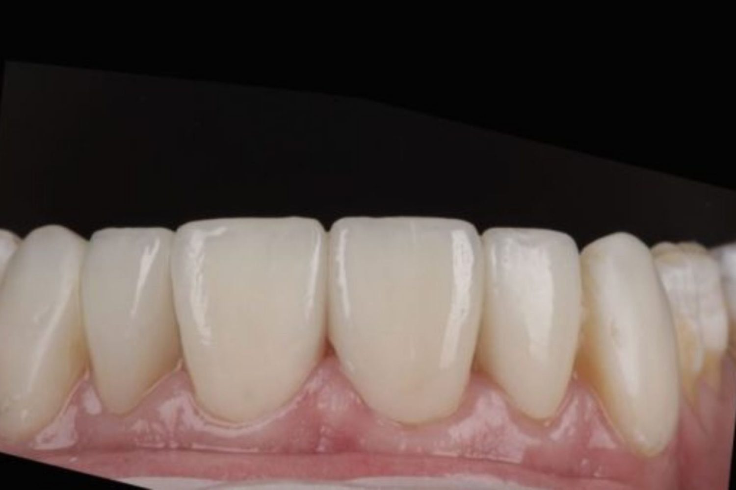 Patient smile after composite veneers at Maida Smiles, Maida Vale