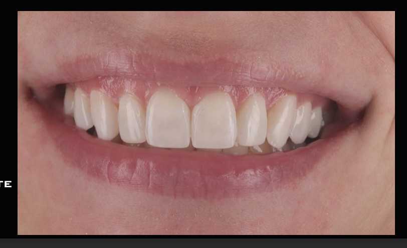 Patient smile after Invisalign and composite bonding at Maida Smiles