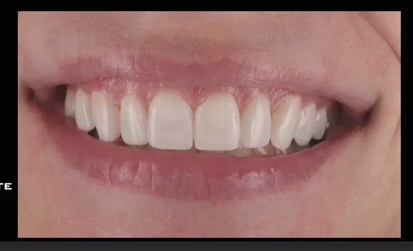 Patient smile after Invisalign and composite bonding at Maida Smiles