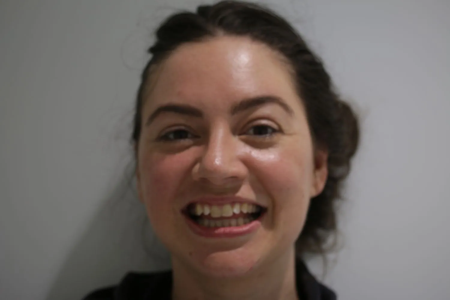 Patient teeth before Invisalign treatment at Maida Smiles