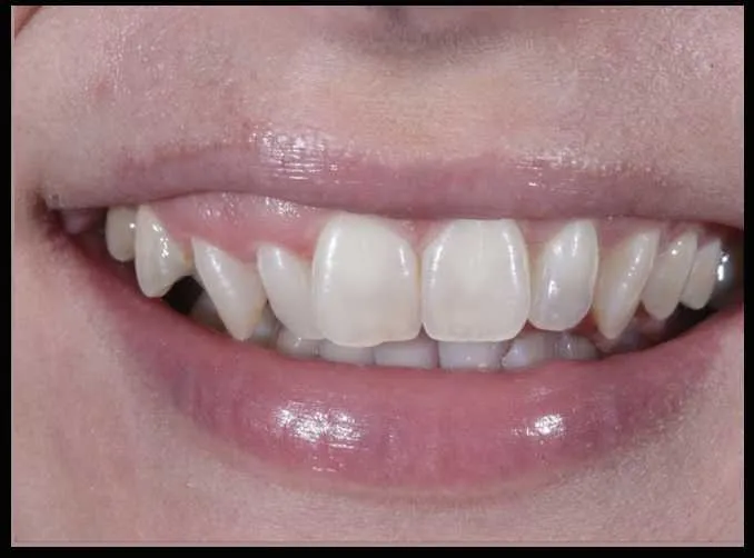 Patient with narrow crooked teeth before Invisalign at Maida Smiles