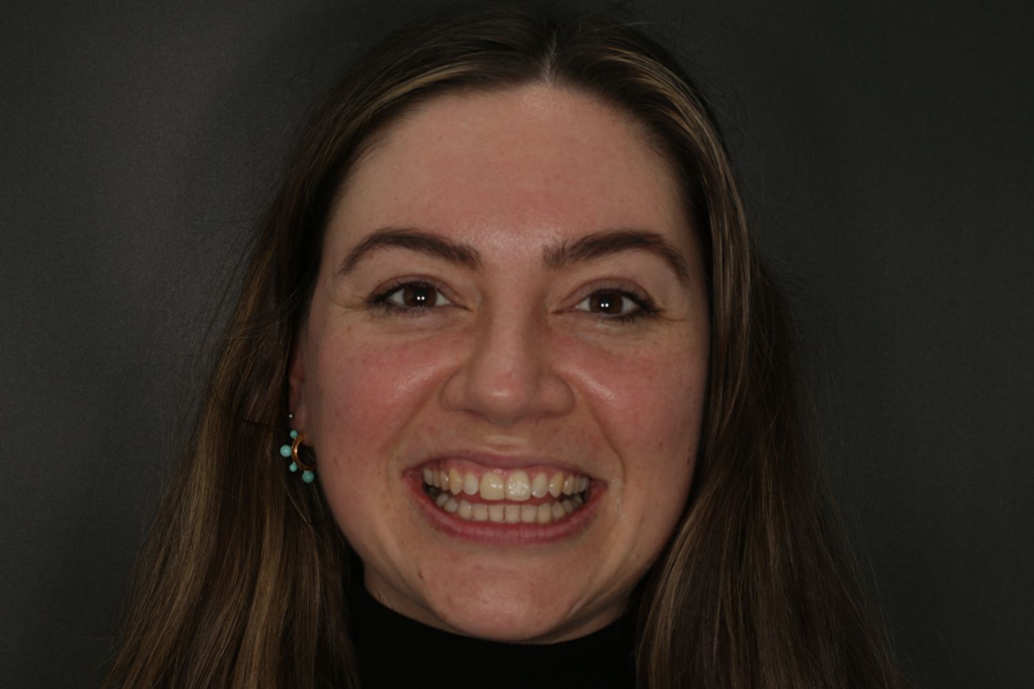 Patient smile after Invisalign teeth straightening at Maida Smiles