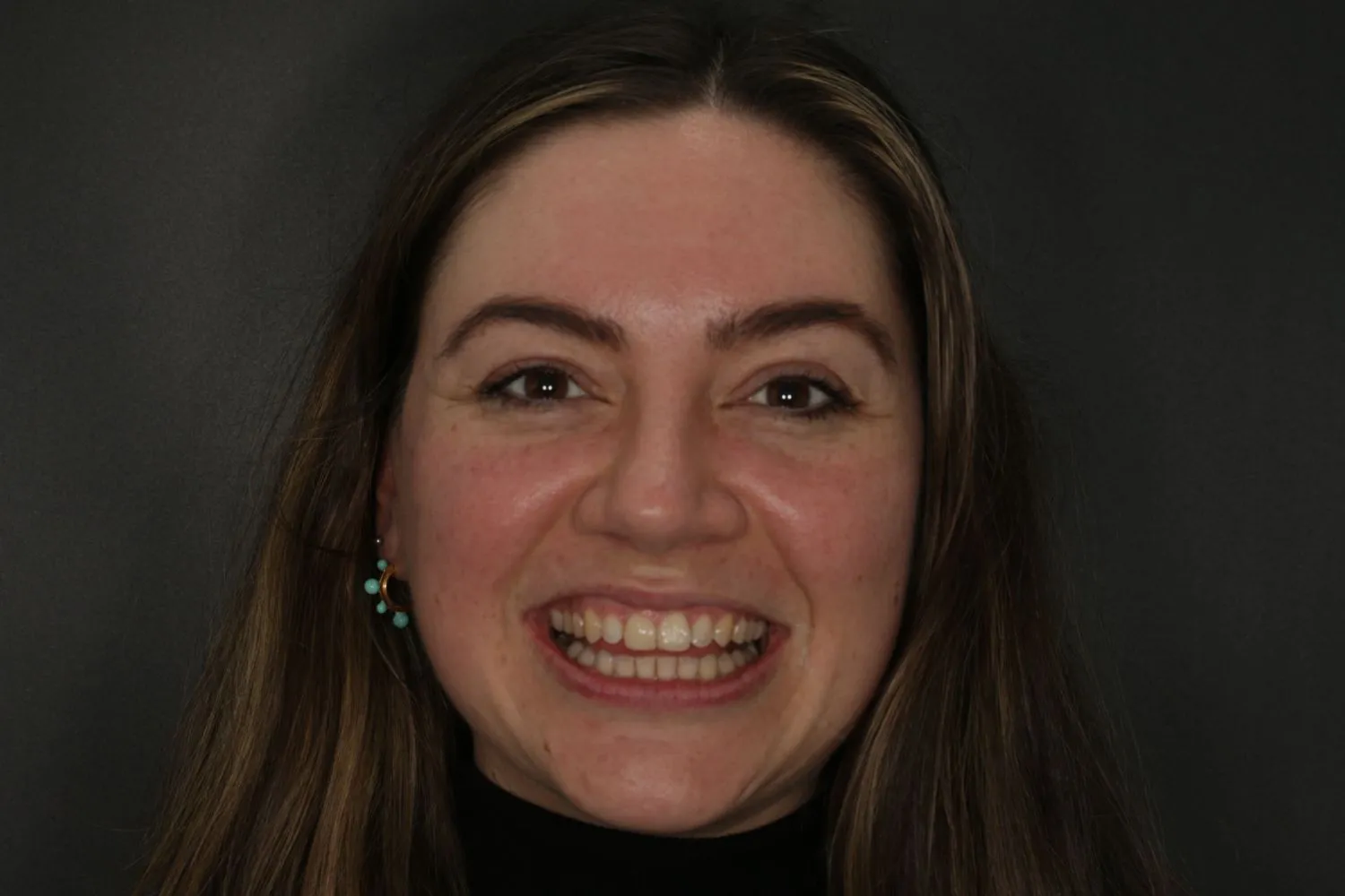 Patient smile after Invisalign teeth straightening at Maida Smiles