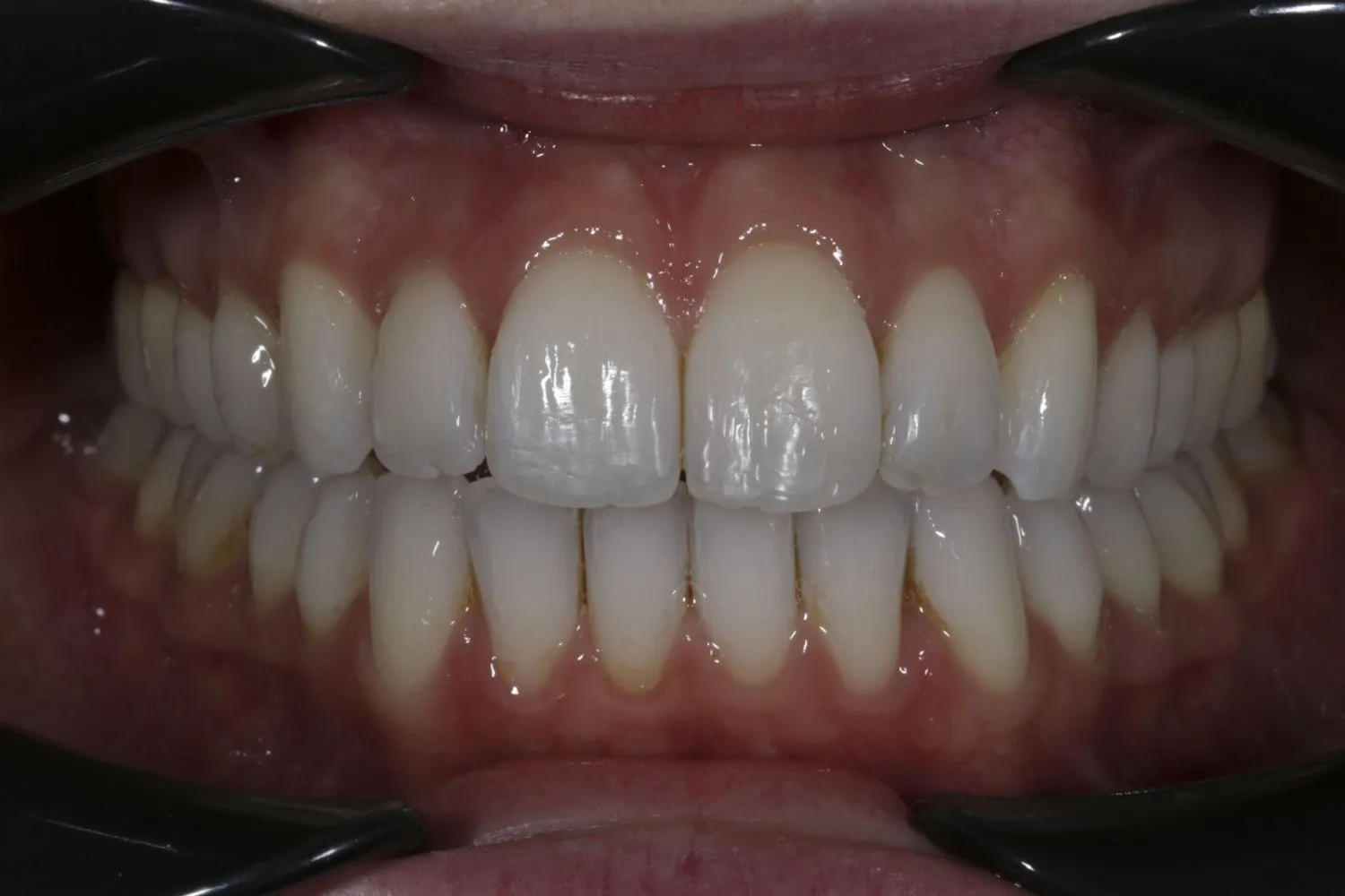 Patient smile after Invisalign teeth straightening at Maida Smiles