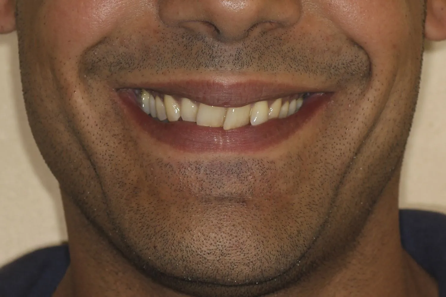 Patient teeth before Invisalign at Maida Smiles