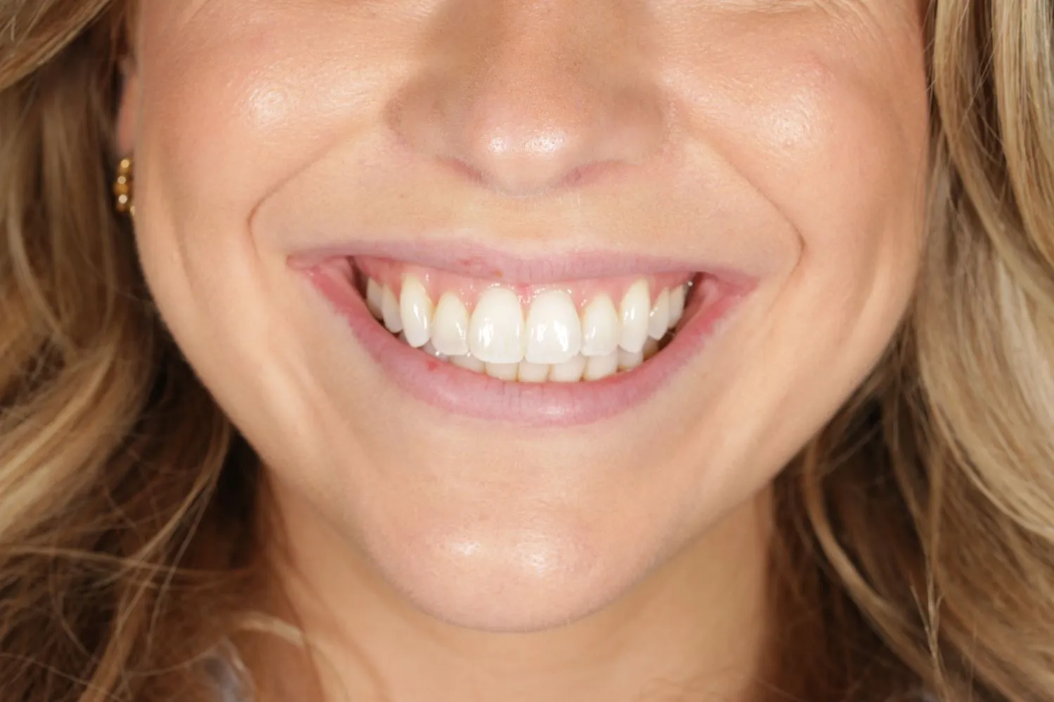Patient smile after Invisalign overbite correction at Maida Smiles