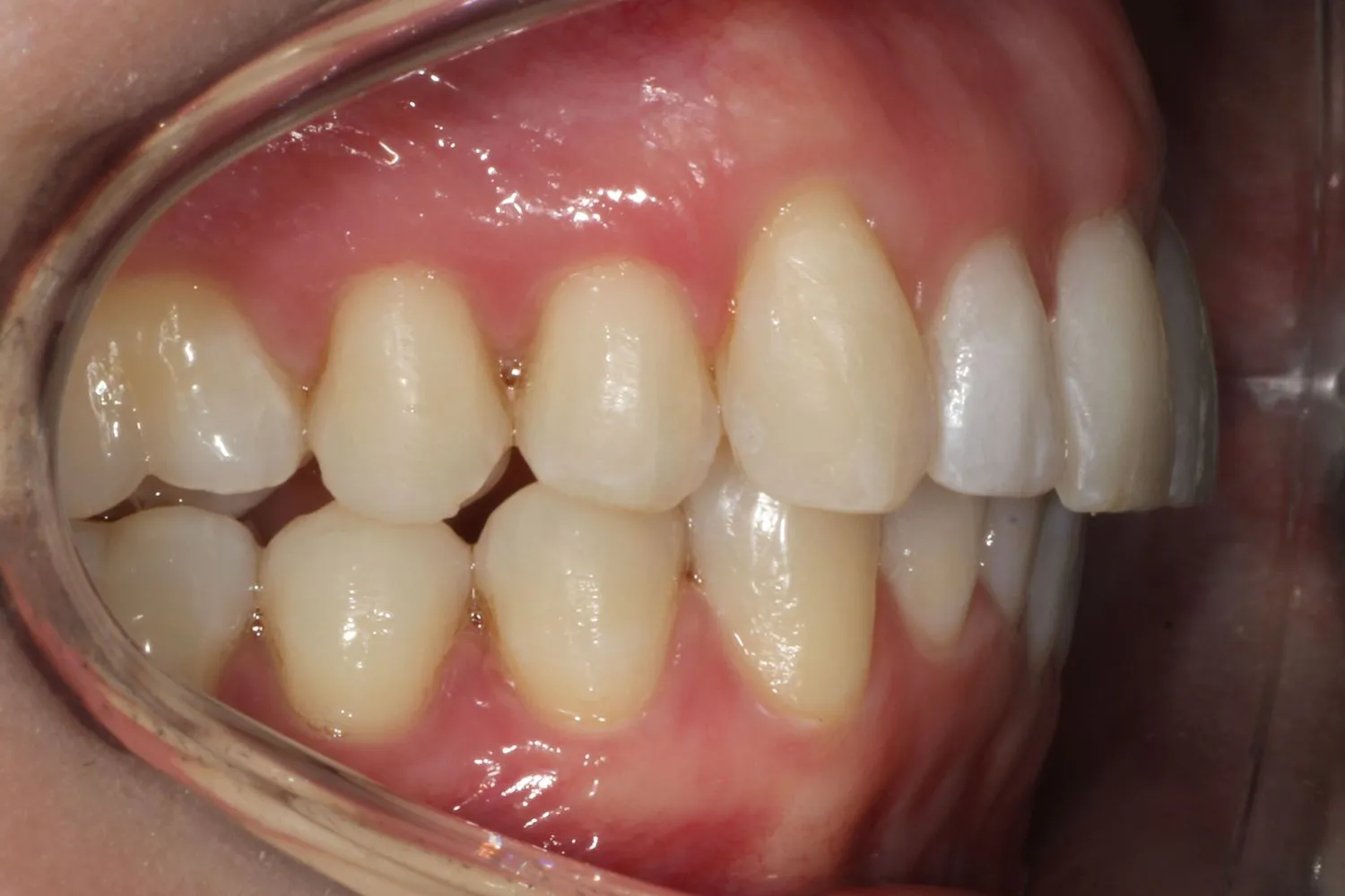 Patient smile after Invisalign teeth straightening at Maida Smiles